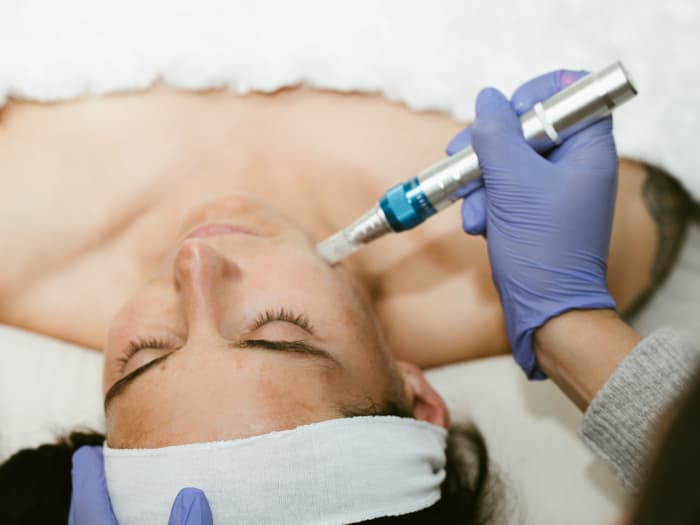 microneedling4